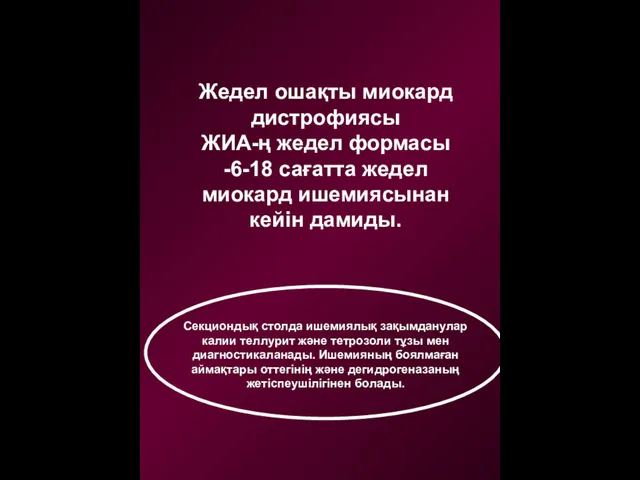 Жедел ошақты миокард дистрофиясы ЖИА-ң жедел формасы -6-18 сағатта жедел