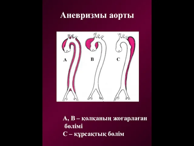 Аневризмы аорты А, В – қолқаның жоғарлаған бөлімі С – құрсақтық бөлім
