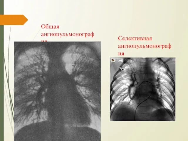 Общая ангиопульмонография Селективная ангиопульмонография