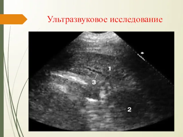 Ультразвуковое исследование