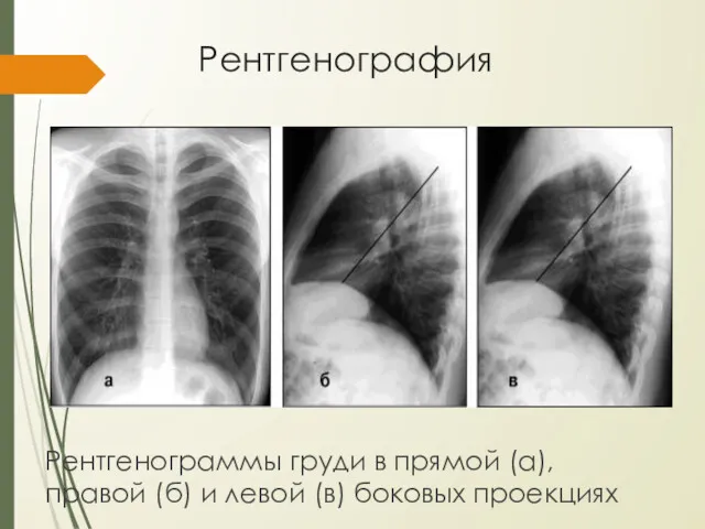 Рентгенография Рентгенограммы груди в прямой (а), правой (б) и левой (в) боковых проекциях