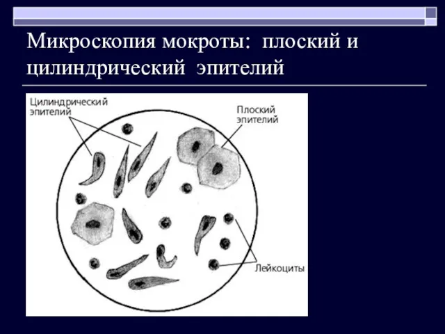 Микроскопия мокроты: плоский и цилиндрический эпителий