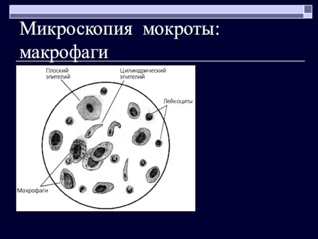 Микроскопия мокроты: макрофаги