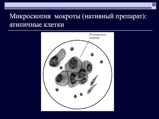 Микроскопия мокроты (нативный препарат): атипичные клетки