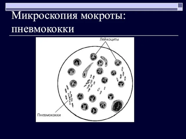 Микроскопия мокроты: пневмококки
