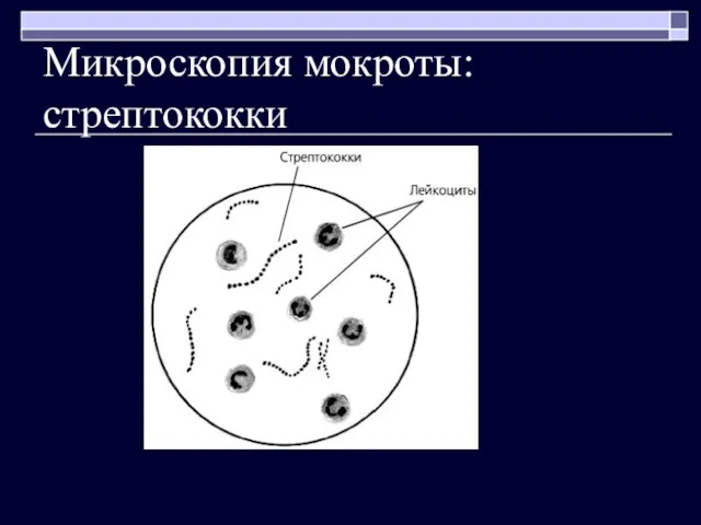 Микроскопия мокроты: стрептококки