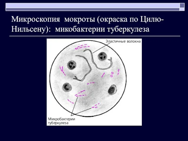 Микроскопия мокроты (окраска по Цилю- Нильсену): микобактерии туберкулеза