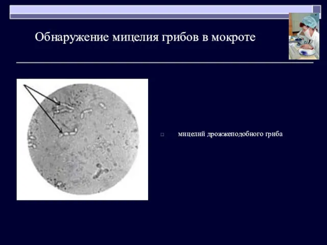 Обнаружение мицелия грибов в мокроте мицелий дрожжеподобного гриба