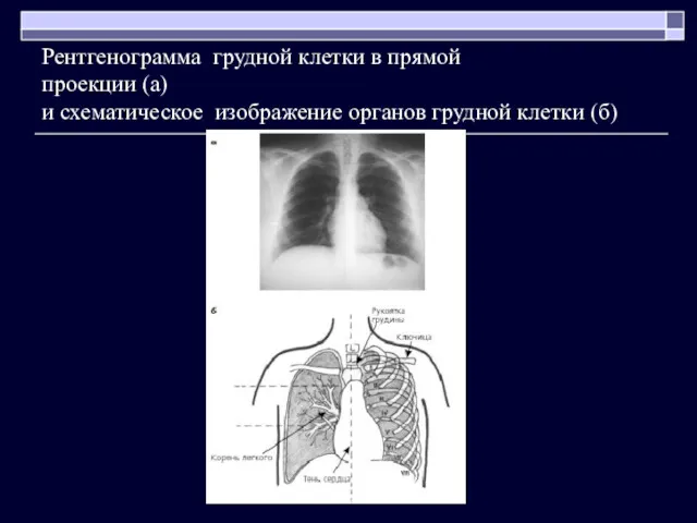 Рентгенограмма грудной клетки в прямой проекции (а) и схематическое изображение органов грудной клетки (б)
