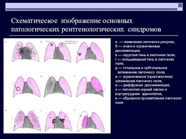 Схематическое изображение основных патологических рентгенологических синдромов а — изменение легочного рисунка, б —