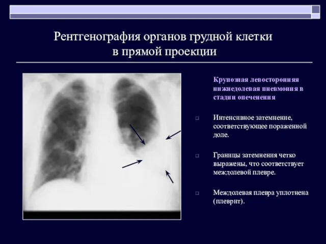 Рентгенография органов грудной клетки в прямой проекции Крупозная левосторонняя нижнедолевая пневмония в стадии