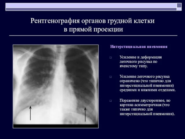 Рентгенография органов грудной клетки в прямой проекции Интерстициальная пневмония Усиление
