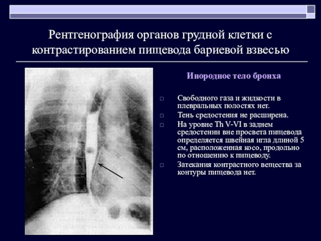 Рентгенография органов грудной клетки с контрастированием пищевода бариевой взвесью Инородное тело бронха Свободного