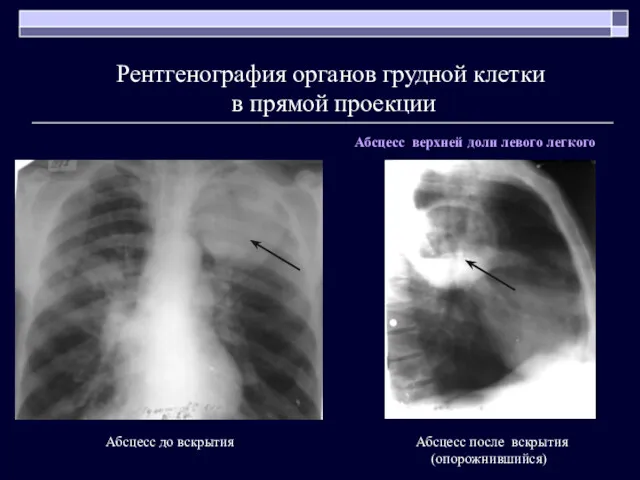 Абсцесс после вскрытия (опорожнившийся) Рентгенография органов грудной клетки в прямой проекции Абсцесс до