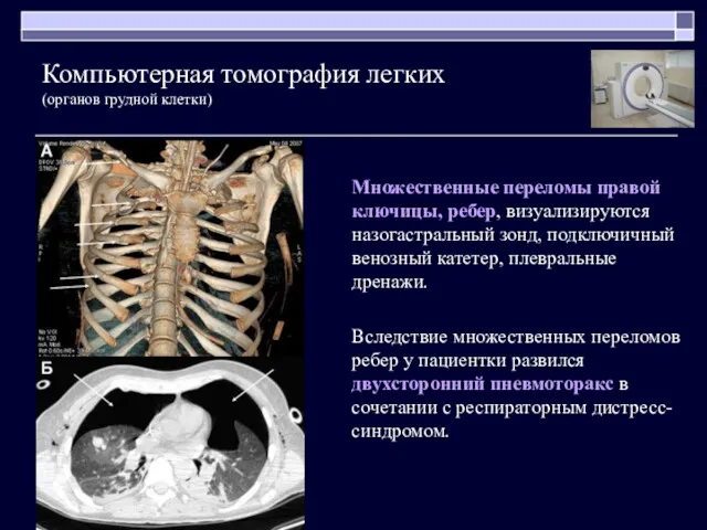 Множественные переломы правой ключицы, ребер, визуализируются назогастральный зонд, подключичный венозный катетер, плевральные дренажи.