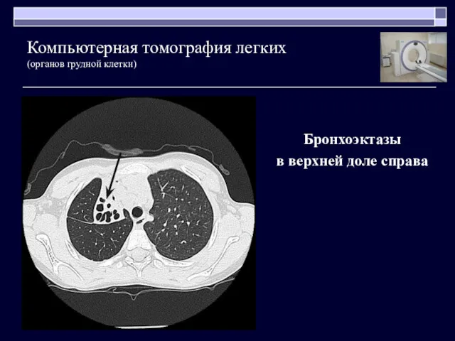 Бронхоэктазы в верхней доле справа Компьютерная томография легких (органов грудной клетки)