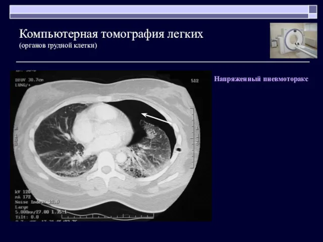 Напряженный пневмоторакс Компьютерная томография легких (органов грудной клетки)