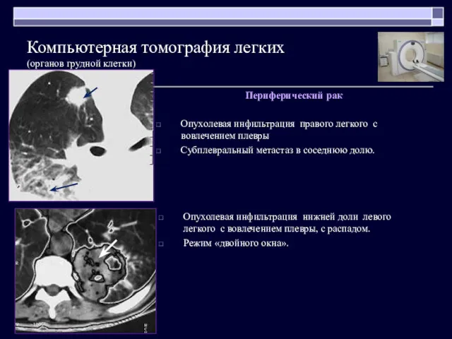 Периферический рак Опухолевая инфильтрация правого легкого с вовлечением плевры Субплевральный метастаз в соседнюю