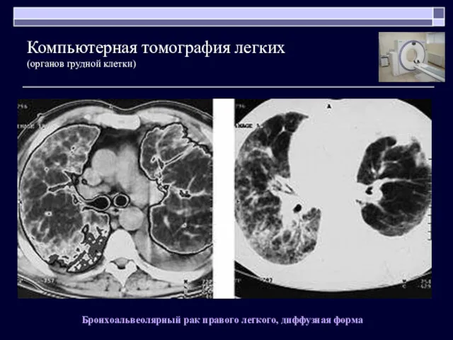 Бронхоальвеолярный рак правого легкого, диффузная форма Компьютерная томография легких (органов грудной клетки)