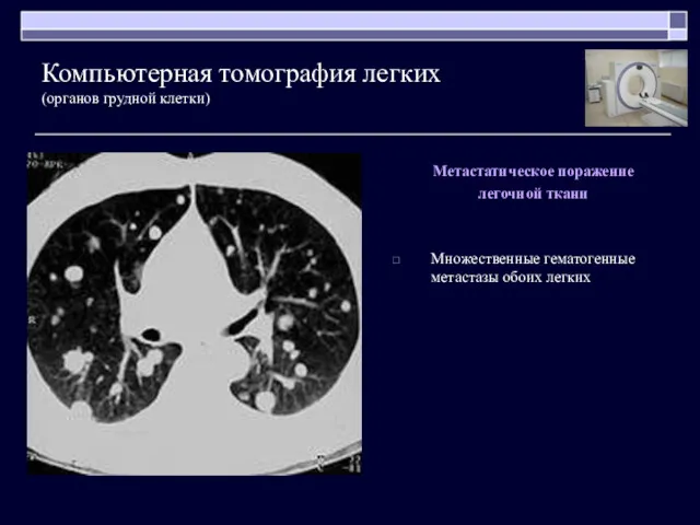 Метастатическое поражение легочной ткани Множественные гематогенные метастазы обоих легких Компьютерная томография легких (органов грудной клетки)