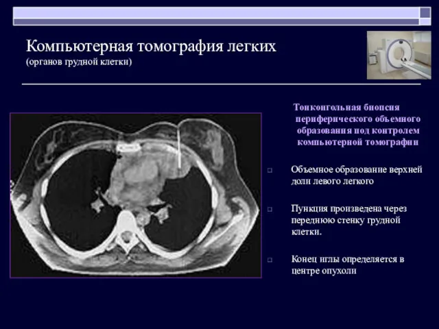 Тонкоигольная биопсия периферического объемного образования под контролем компьютерной томографии Объемное