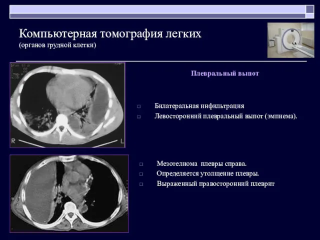 Билатеральная инфильтрация Левосторонний плевральный выпот (эмпиема). Компьютерная томография легких (органов грудной клетки) Мезотелиома