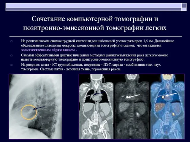 Сочетание компьютерной томографии и позитронно-эмиссионной томографии легких На рентгеновском снимке грудной клетки виден
