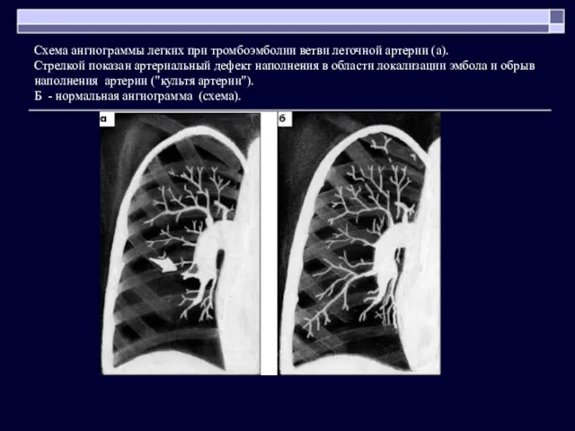 Схема ангиограммы легких при тромбоэмболии ветви легочной артерии (а). Стрелкой показан артериальный дефект