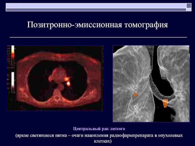 Позитронно-эмиссионная томография Центральный рак легкого (яркие светящиеся пятна – очаги накопления радиофармпрепарата в опухолевых клетках)