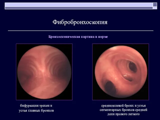 Фибробронхоскопия среднедолевой бронх и устья сегментарных бронхов средней доли правого легкого бифуркация трахеи