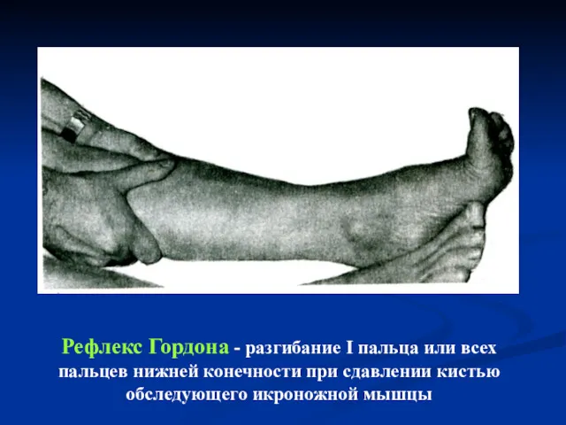 Рефлекс Гордона - разгибание I пальца или всех пальцев нижней конечности при сдавлении