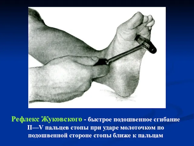 Рефлекс Жуковского - быстрое подошвенное сгибание II—V пальцев стопы при ударе молоточком по
