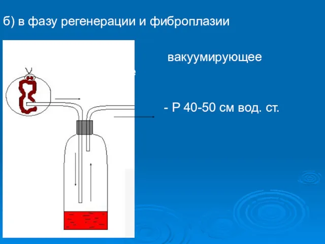 б) в фазу регенерации и фиброплазии вакуумирующее дренирование - Р 40-50 см вод. ст.