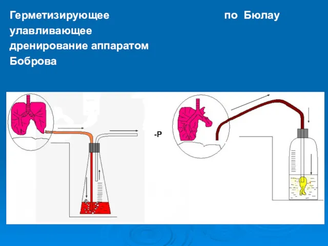 Герметизирующее по Бюлау улавливающее дренирование аппаратом Боброва -Р