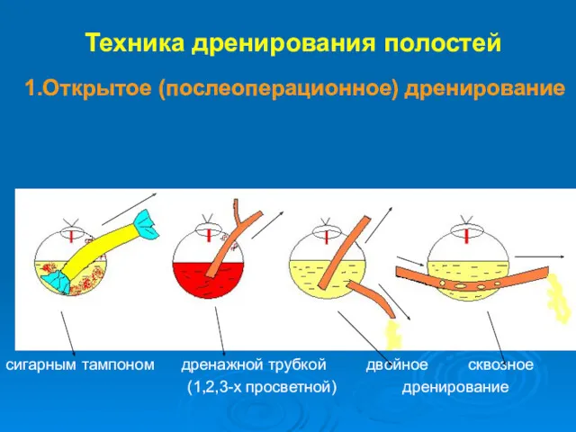 Техника дренирования полостей 1.Открытое (послеоперационное) дренирование сигарным тампоном дренажной трубкой двойное сквозное (1,2,3-х просветной) дренирование