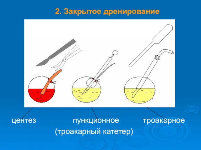 2. Закрытое дренирование центез пункционное троакарное (троакарный катетер)