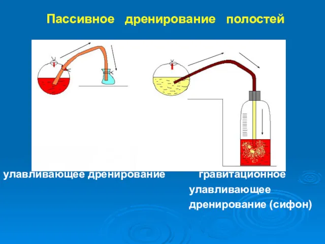 Пассивное дренирование полостей улавливающее дренирование гравитационное улавливающее дренирование (сифон)