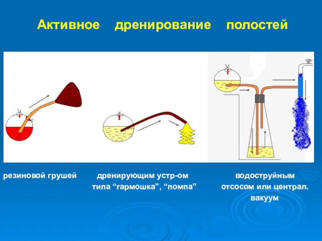 Активное дренирование полостей резиновой грушей дренирующим устр-ом водоструйным типа “гармошка”, “помпа” отсосом или централ. вакуум