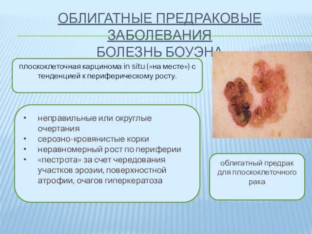 ОБЛИГАТНЫЕ ПРЕДРАКОВЫЕ ЗАБОЛЕВАНИЯ БОЛЕЗНЬ БОУЭНА плоскоклеточная карцинома in situ («на