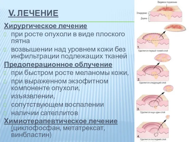 V. ЛЕЧЕНИЕ Хирургическое лечение при росте опухоли в виде плоского