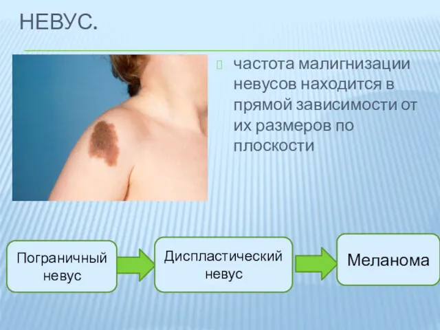 НЕВУС. частота малигнизации невусов находится в прямой зависимости от их