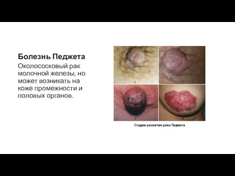 Болезнь Педжета Околососковый рак молочной железы, но может возникать на коже промежности и половых органов.