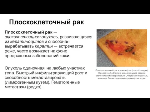 Плоскоклеточный рак Плоскоклеточный рак — злокачественная опухоль, развивающаяся из кератиноцитов