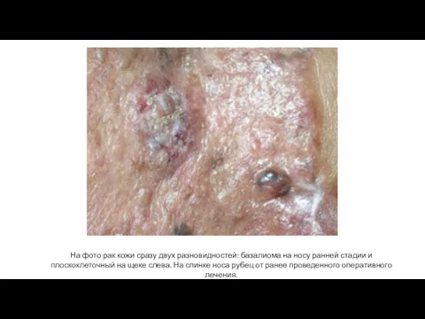 На фото рак кожи сразу двух разновидностей: базалиома на носу