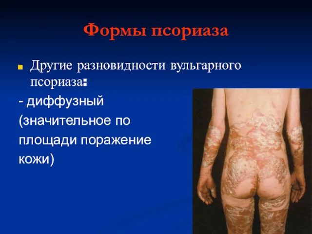 Формы псориаза Другие разновидности вульгарного псориаза: - диффузный (значительное по площади поражение кожи)