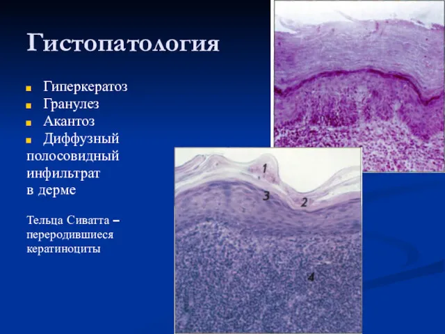 Гистопатология Гиперкератоз Гранулез Акантоз Диффузный полосовидный инфильтрат в дерме Тельца Сиватта – переродившиеся кератиноциты