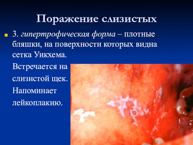 Поражение слизистых 3. гипертрофическая форма – плотные бляшки, на поверхности