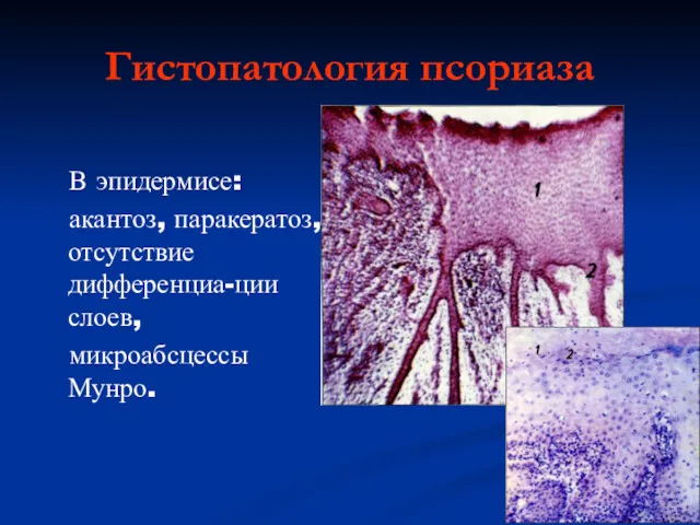 Гистопатология псориаза В эпидермисе: акантоз, паракератоз, отсутствие дифференциа-ции слоев, микроабсцессы Мунро.