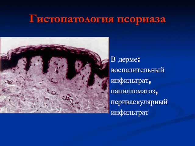 Гистопатология псориаза В дерме: воспалительный инфильтрат, папилломатоз, периваскулярный инфильтрат