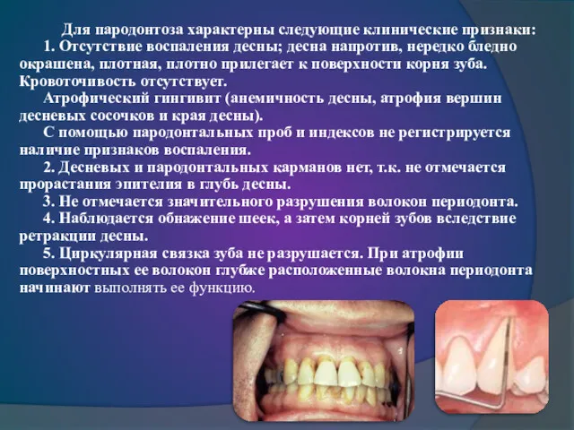 Для пародонтоза характерны следующие клинические признаки: 1. Отсутствие воспаления десны;